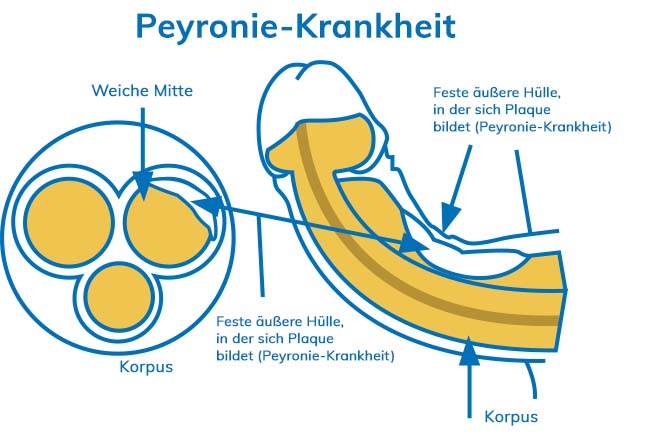 Diamgram: Peyronie's Disease